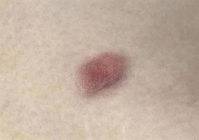 Atrophic dermatofibrosarcoma protuberans: Two case reports and literature review